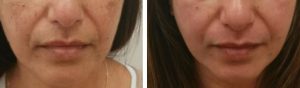 skin whitening cream before & after