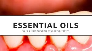 Using-essential-oils-for-bleeding-gums