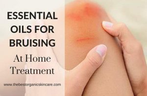essential-oils-for-bruising-at-home-treatment
