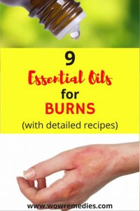 essential-oils-for-burns