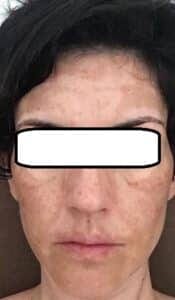 Melasma