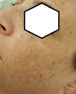 Hyperpigmentation