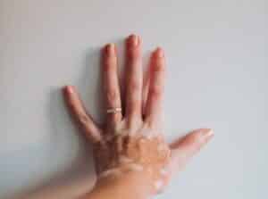 Vitiligo