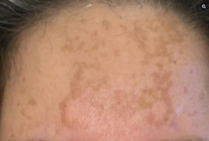 Hyperpigmentation