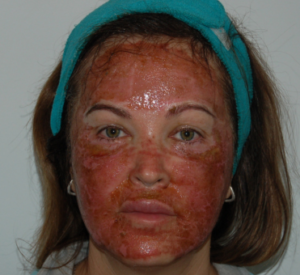 A woman's face 3 days after laser resurfacing all red and flaky